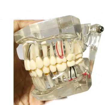 Dantų Tyrimas, Dantų Skaidrus Suaugusiųjų Patologinių & Ligos Dantys Modelis